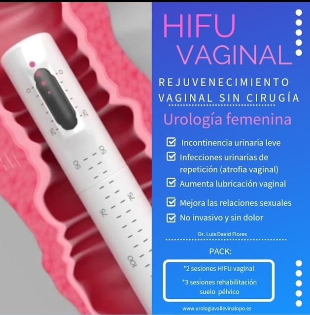 HIFU vaginal