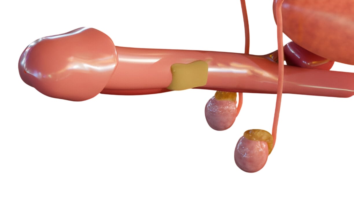 cirugia correccion peyronie torrevieja